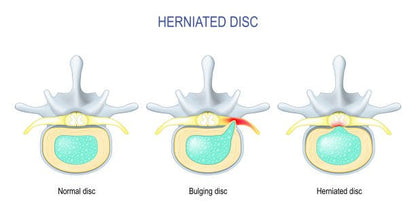 2900. Musculoskeleton 1) Disc Herniation - DrSous.Ca