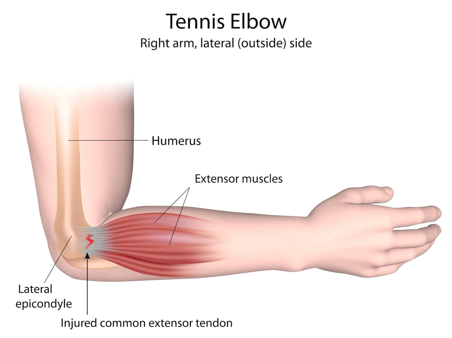 2906.Musculoskeleton. 7. Tendonitis (Golfers Elbow,Tennis Elbow) - DrSous.Ca