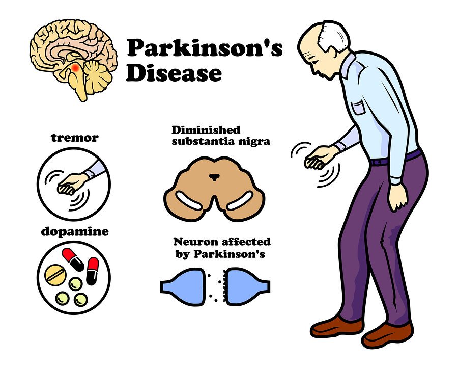 2916.Head & Spinal Cord 6)Parkinsons Disease - DrSous.Ca