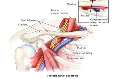 2921. Head & Spinal Cord 11)Thoracis Outlet Syndrome - DrSous.Ca
