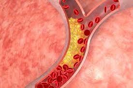 2924.Blood, Heart & Cholesterol 3) High Cholesterol - DrSous.Ca