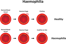 2932.Blood,Heart & Cholesterol 11)Hemophilia - DrSous.Ca